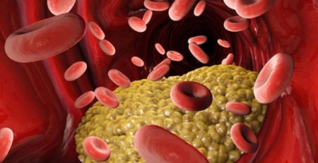 Ácido bempedóico reduz risco de eventos cardiovasculares em doentes com possibilidade de DCVA